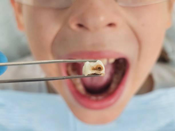 Best Emergency Dentist for Knocked-Out Tooth in Ashland, VA